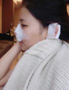 许英哲肋软骨隆鼻恢复日记分享~ width=