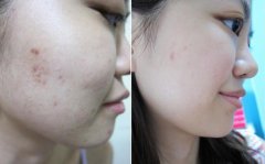 彩光嫩肤去痘价格多少钱?影响因素有哪些? width=