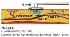 光纤微创溶脂大概多少钱?听说贵得有点离谱? width=