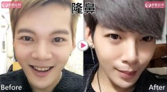 什么是分段式假体隆鼻?分段式假体隆鼻的原理? width=