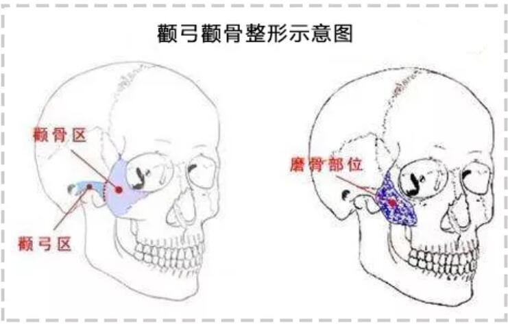 下颌角接骨整形技术