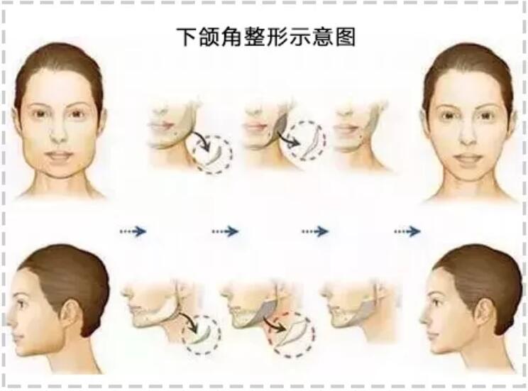 下颌角接骨整形技术