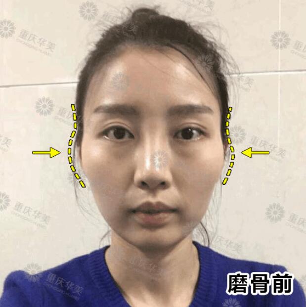 下颌角接骨整形技术