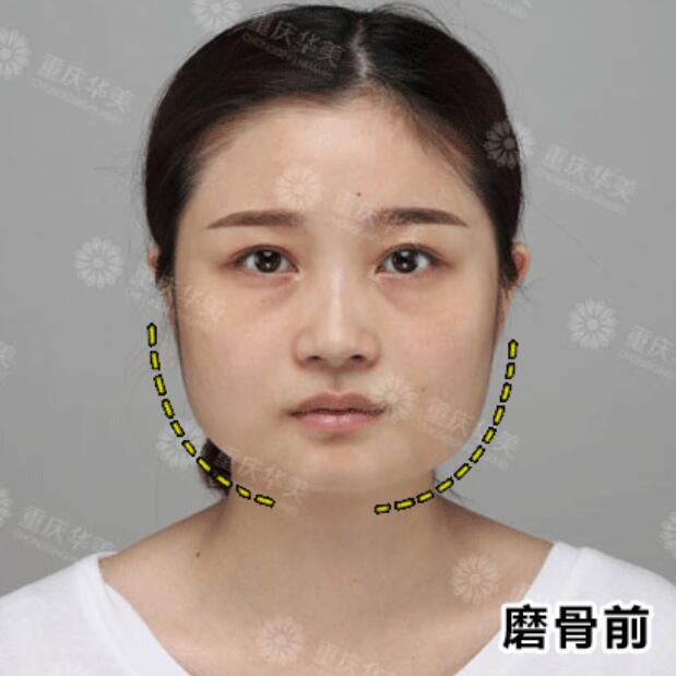 下颌角接骨整形技术