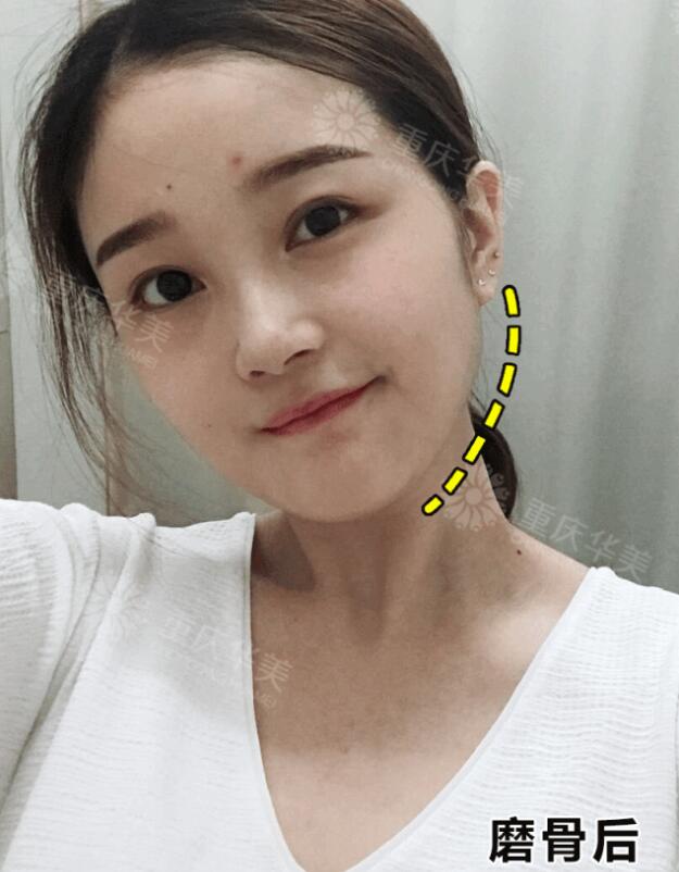 下颌角接骨整形技术