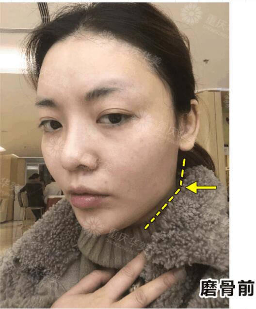 下颌角接骨整形技术