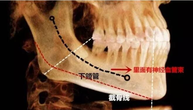 下颌角接骨整形技术
