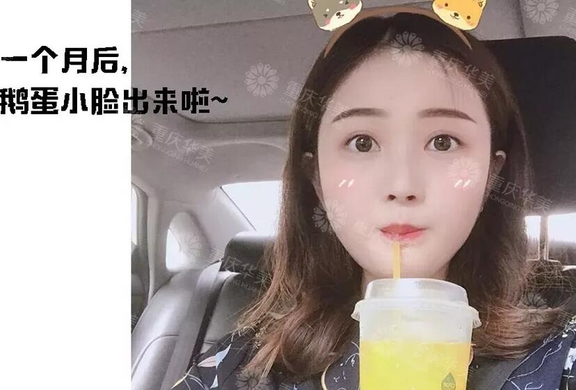 下颌角接骨整形技术