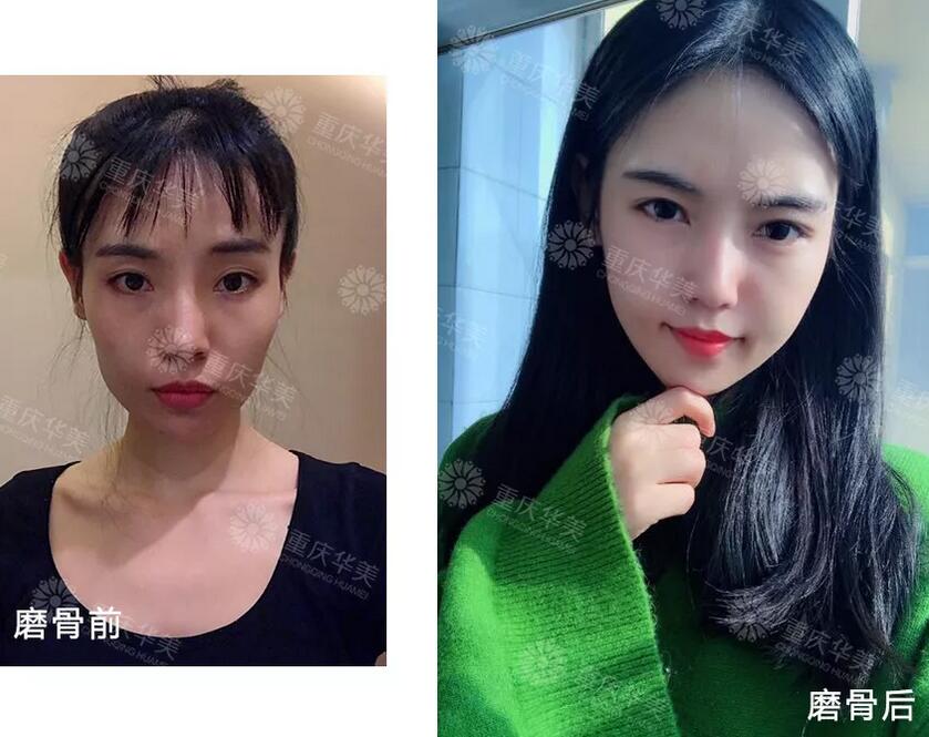 下颌角接骨整形技术