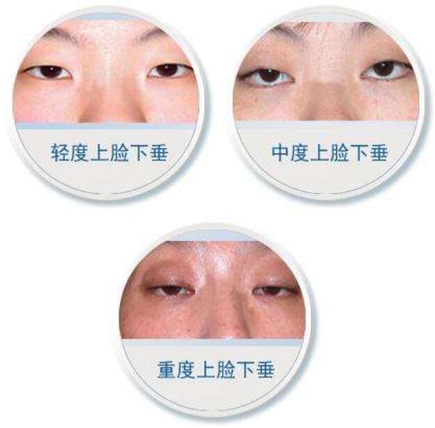 上睑下垂怎么矫正好？华美紫馨急速纳米美眼技术灰常妙！
