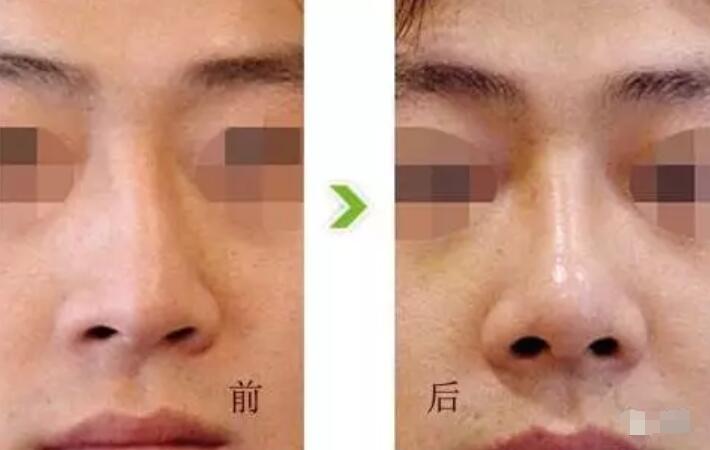 鼻孔缩小手术对比图