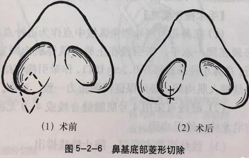 鼻孔缩小手术对比图