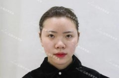 塌鼻子隆鼻前后对比真实分享——刘攀医生技术很棒~ width=