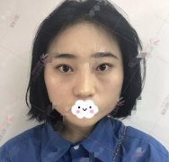 等离子光纤溶脂瘦脸3个月恢复图分享|等离子光纤溶脂牛啤！ width=