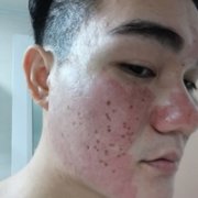 像素激光祛痘多少钱?专业技师为你解答 width=