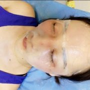 c8激光祛斑果怎么样?看我如何成功逆袭 width=