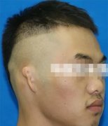 米兰柏羽全耳再造技术如何，真人案例解析 width=