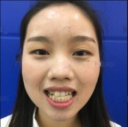仁雁口腔半隐形陶瓷矫正对比图：一口好牙带来的改变 width=