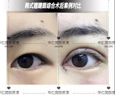 韩式翘睫双眼皮好不好?