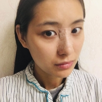 巫文云隆鼻果如何?真像广告上说的那样好?