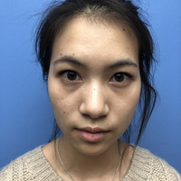 李芳整形果如何?双眼真实案例为你诠释