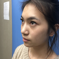 李芳整形果如何?双眼真实案例为你诠释