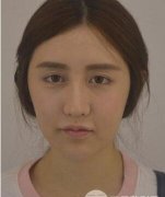 面部吸脂果图，个人真实案例解析~ width=