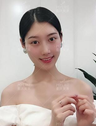 重庆美莱隆鼻梁真实案例昏享，千万不要错过~