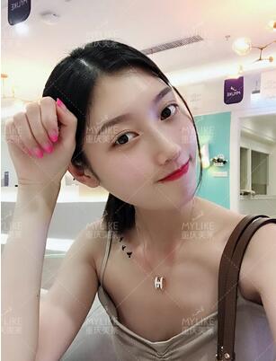 重庆美莱隆鼻梁真实案例昏享，千万不要错过~