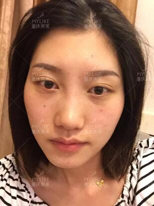 重庆美莱隆鼻梁真实案例昏享，千万不要错过~