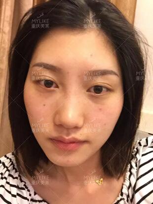 重庆美莱隆鼻梁介绍昏享，千万不要错过~