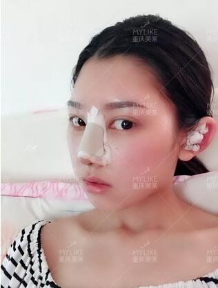 重庆美莱隆鼻梁真实案例昏享，千万不要错过~