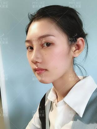 重庆美莱隆鼻梁真实案例昏享，千万不要错过~