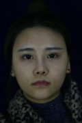 沈阳杏林下颌角接骨整形技术恢复半年后，励志逆袭18线小艺人 width=
