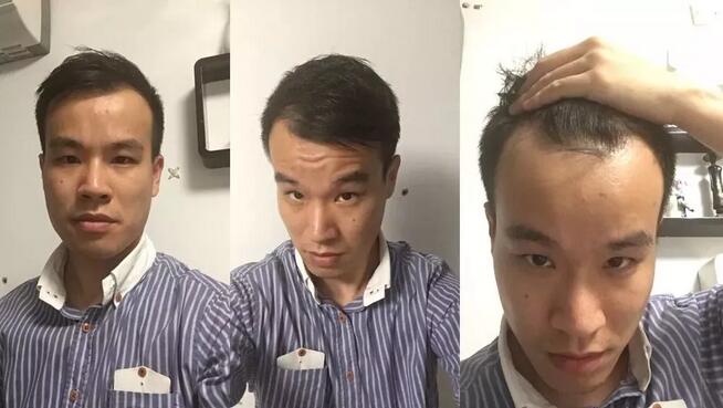 南昌宏昌植发医院fut微创植发技术靠谱吗？一起来见证！