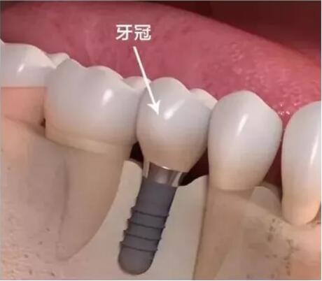 珠海九龙医院第一1届种植观摩会，  看直播0元抽奖赢德国种植体!
