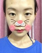 上海天大整形医院熊俊文双眼皮+隆鼻案例一枚，请笑纳~ width=