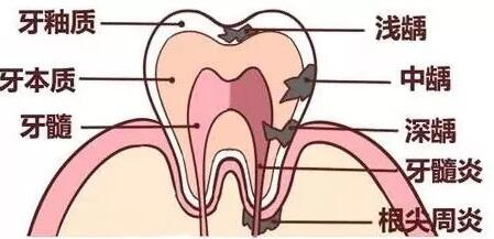 嘉悦国际口腔：龋齿是什么？怎么调节...