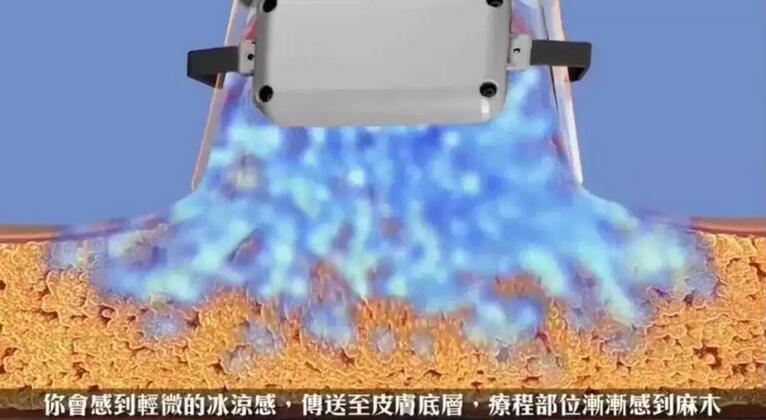 360度环形吸脂——你也能拥有闫妮这样的身材~
