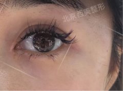西美整形5s重睑术+开眼角术后2周真实分享，错不了~ width=