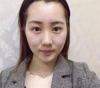 丰太阳穴邱立东在线咨询靠谱吗？少女自述蜕变经历~ width=