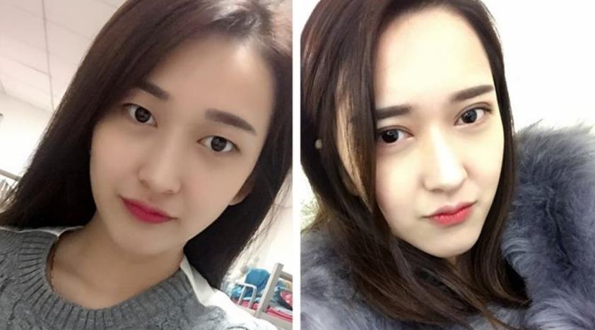 5s重睑术的优势盘点——想做?那你还在犹豫什么?