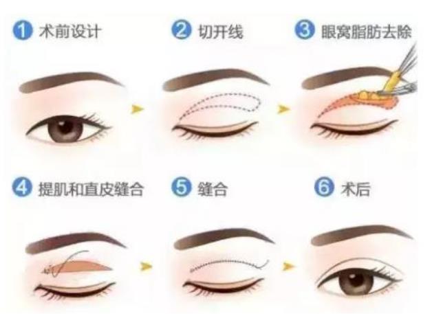 5s重睑术的优势盘点——想做?那你还在犹豫什么?