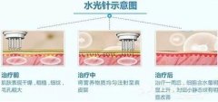 涂抹式水光补水和水光补水有什么区别？科普时间到~ width=