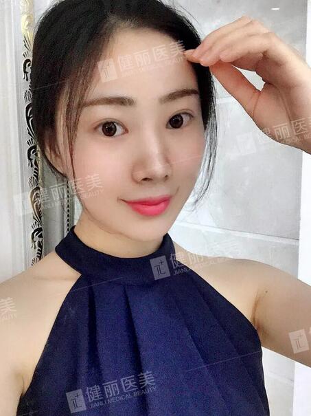 健丽填了脂肪的她气堂全开，  一张少女脸嫩得像18岁？