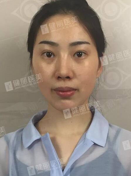 健丽填了脂肪的她气堂全开，  一张少女脸嫩得像18岁？