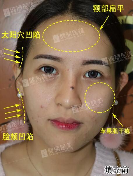 健丽填了脂肪的她气堂全开，  一张少女脸嫩得像18岁？