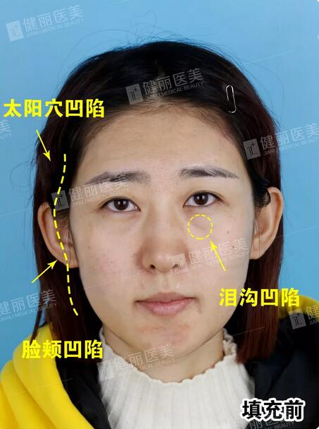 健丽填了脂肪的她气堂全开，  一张少女脸嫩得像18岁？