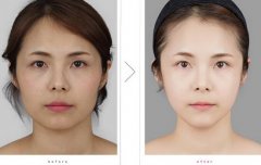 面部光纤溶脂果咋样?听说不错呢~ width=