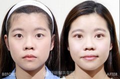 生物焊接双眼皮价格贵吗?SEI来告诉我下喃？! width=